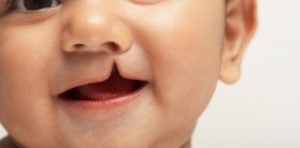 El labio leporino es un defecto congénito que requiere tratamiento específico, que incluye cirugía y cuidados especiales con la alimentación, dentición, audición y con el lenguaje y el habla del bebé o el niño...