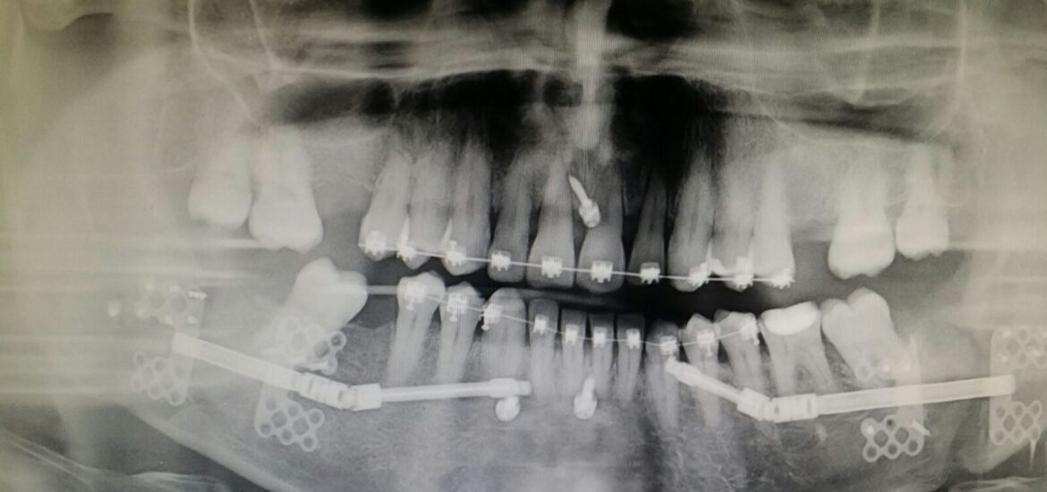 Apnea de sueño curada por el cirujano maxilofacial Antonio Vazquez en Barcelona