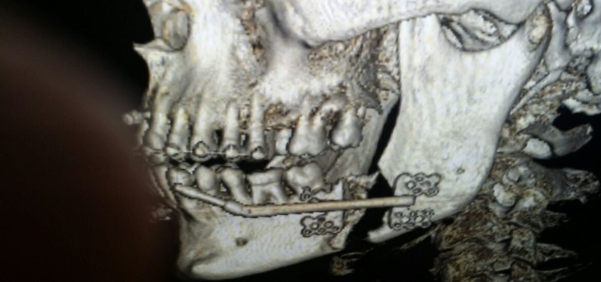 Antonio Vázquez, cirujano maxilofacial en Barcelona cura la apnea de sueño con las intervenciones de mandíbula