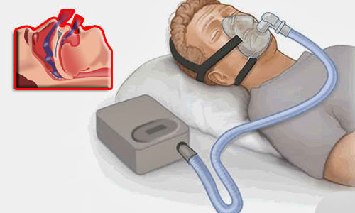 Respiracion con presión positiva (CPAP) El Dr Antonio Vázquez con un alargamiento progresivo de la mandíbula cura la apnea de sueño