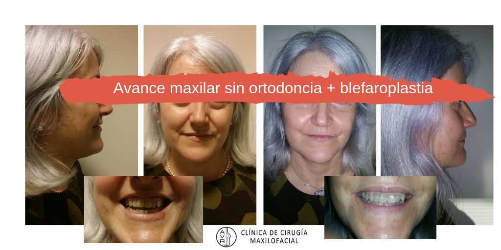 Avance maxilar sin brackets AVR Clínica de Cirugía Maxilofacial en Barcelona Dr. Antonio Vázquez, cirujano maxilofacial en Barcelona