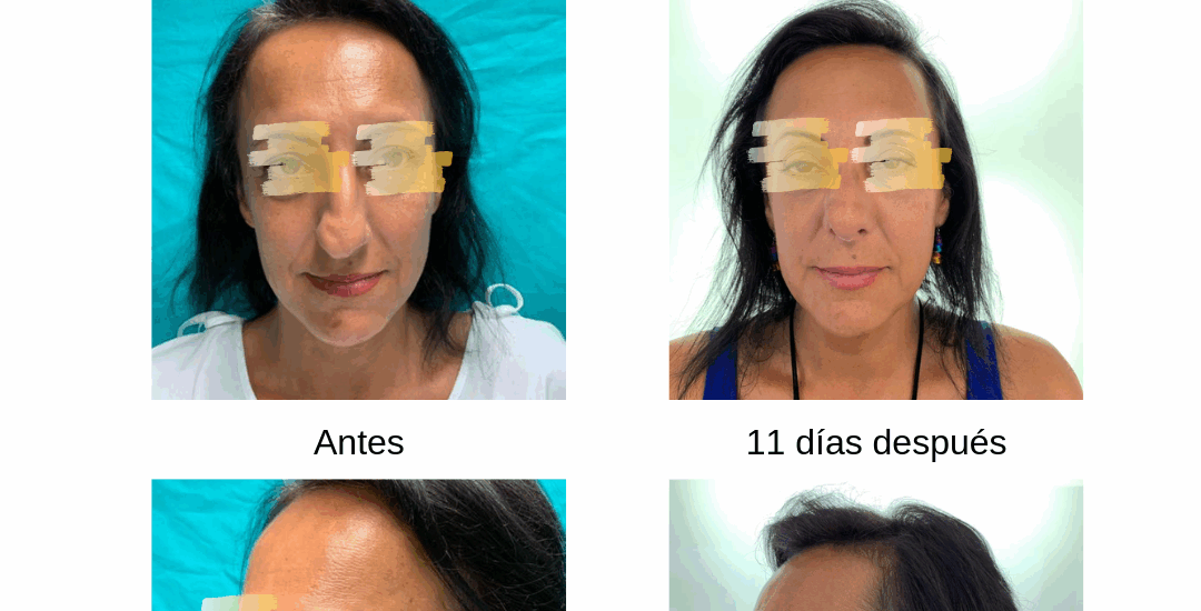 Rinoplastia Ultrasónica 2