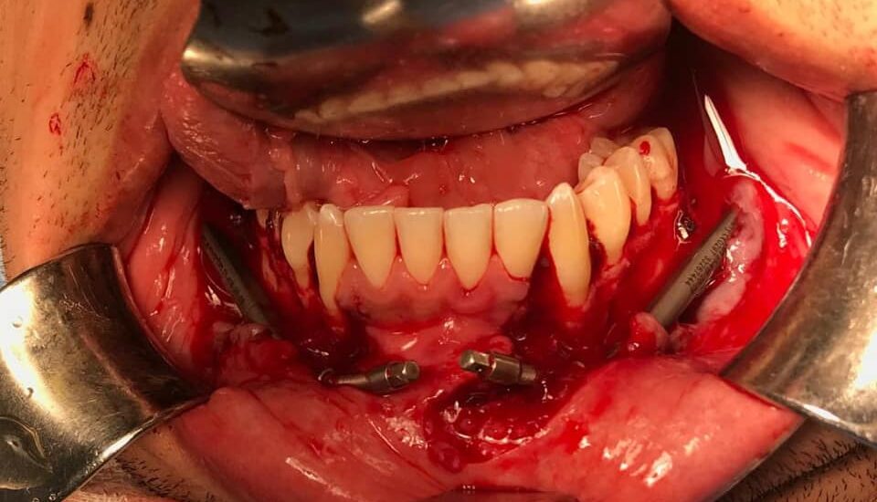 Distracción mandibular tipo IMDO Doctor Antonio Vázquez, cirujano maxilofacial en Barcelona