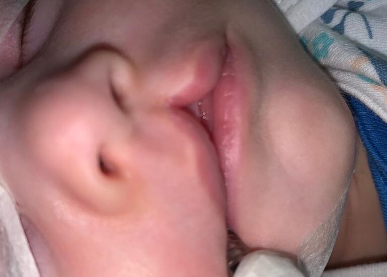 Reparación de labio leporino con técnica millar II Antonio Vazquez, cirujano maxilofacial en Barcelona
