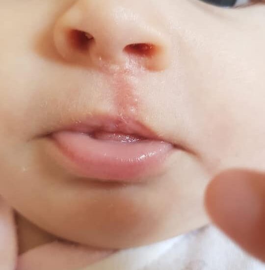 Tres semanas después de la intervención del Labio Leporino Antonio Vazquez,