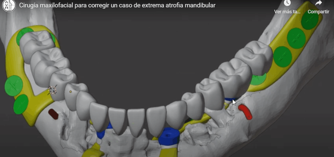 Vídeo de una cirugía maxilofacial para corregir un caso de extrema atrofia mandibular