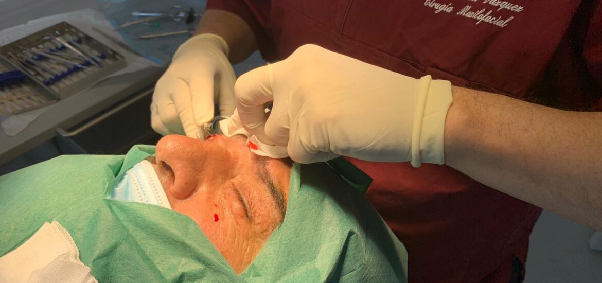 Cirugía de párpados Dr. Antonio Vázquez, Cirujano Maxilofacial en Barcelona