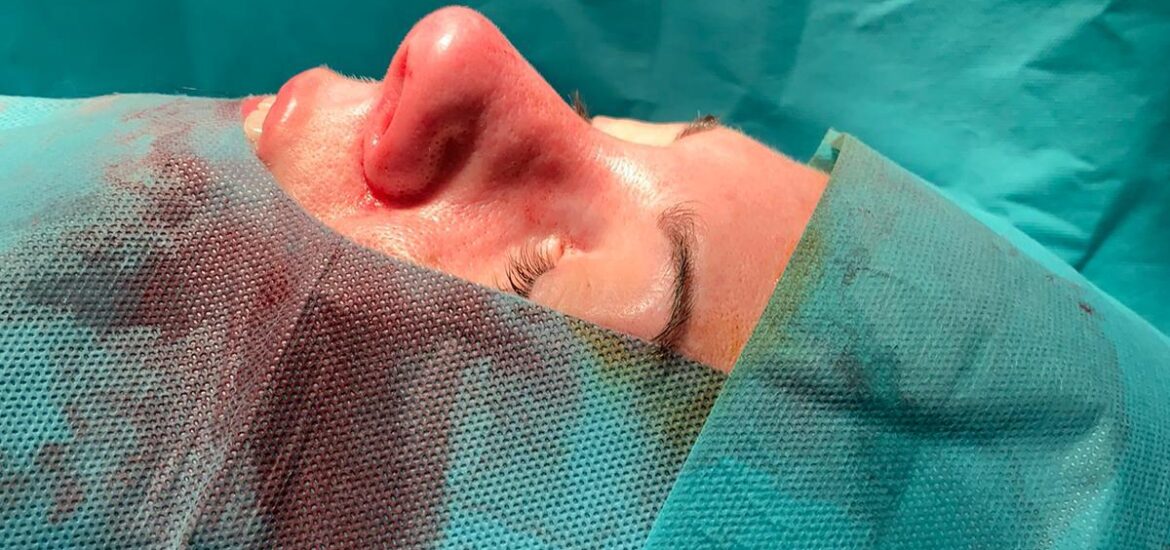 Dr. Antonio Vázquez, cirujano maxilofacial experto en rinoplastia ultrasónica en Barcelona