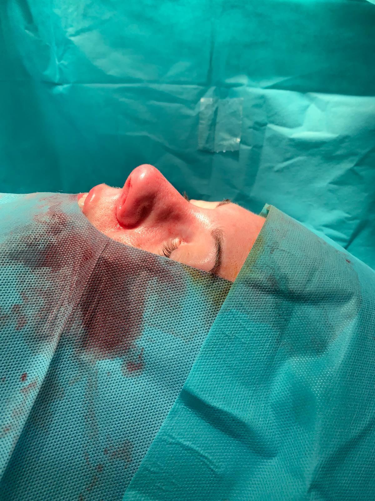 Dr. Antonio Vázquez, cirujano maxilofacial experto en rinoplastia ultrasónica en Barcelona