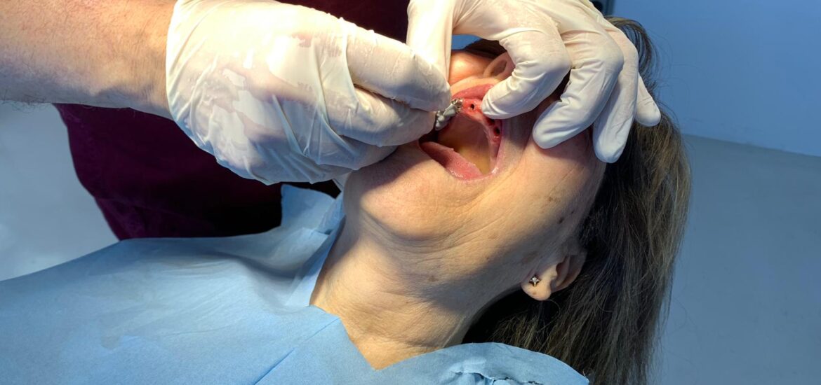 Implantes dentales en la mandíbula superior