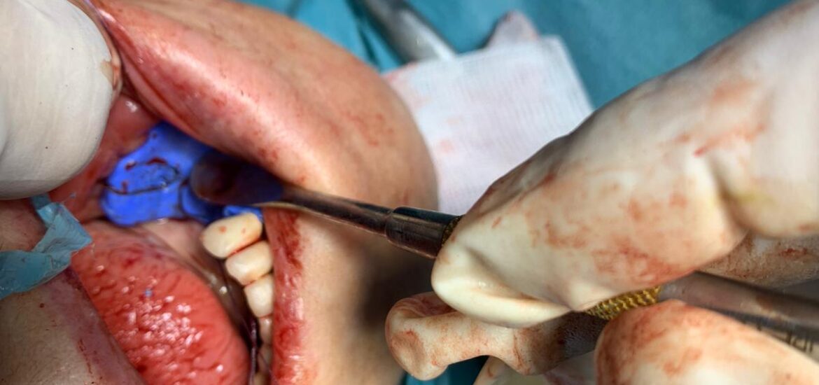 Vestibuloplastia y prótesis de circonio