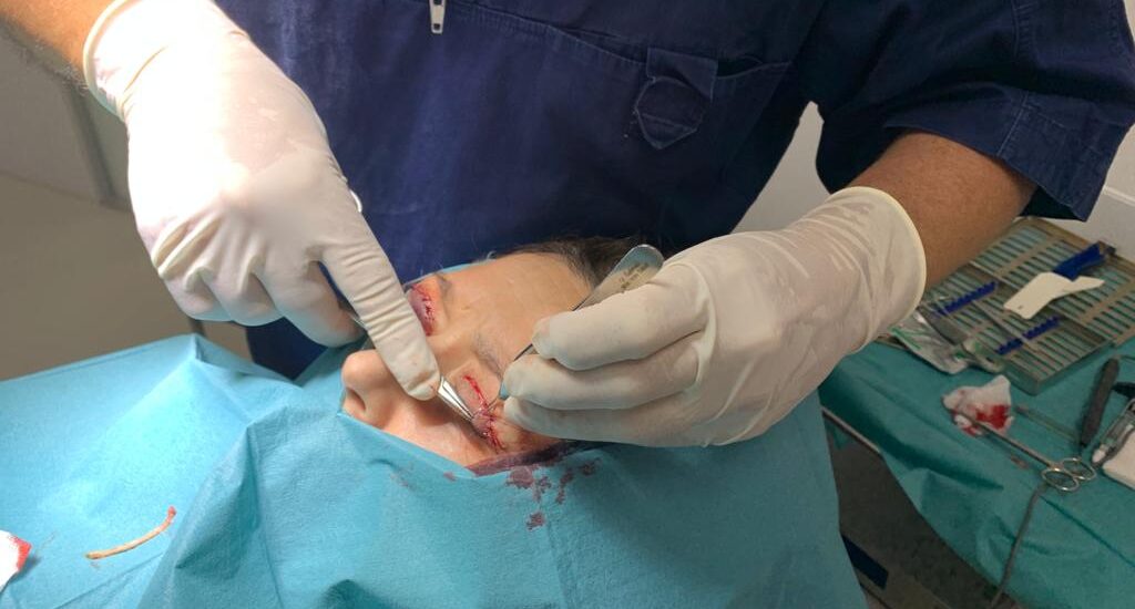 Blefaroplastia superior 2
