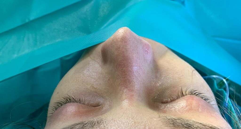 Feminización facial del mentón