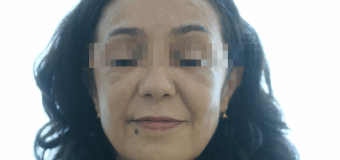 Blefaroplastia y lifting facial con anestesia local AVR Clínica de cirugía maxilofacial en Barcelona