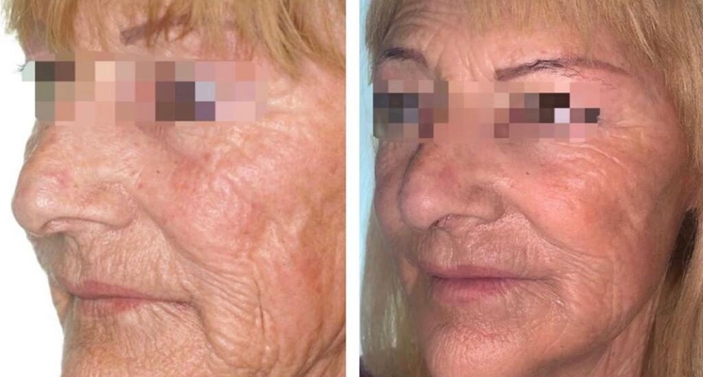 Colocación de prótesis customizada para mandíbula atrófica y lifting facial