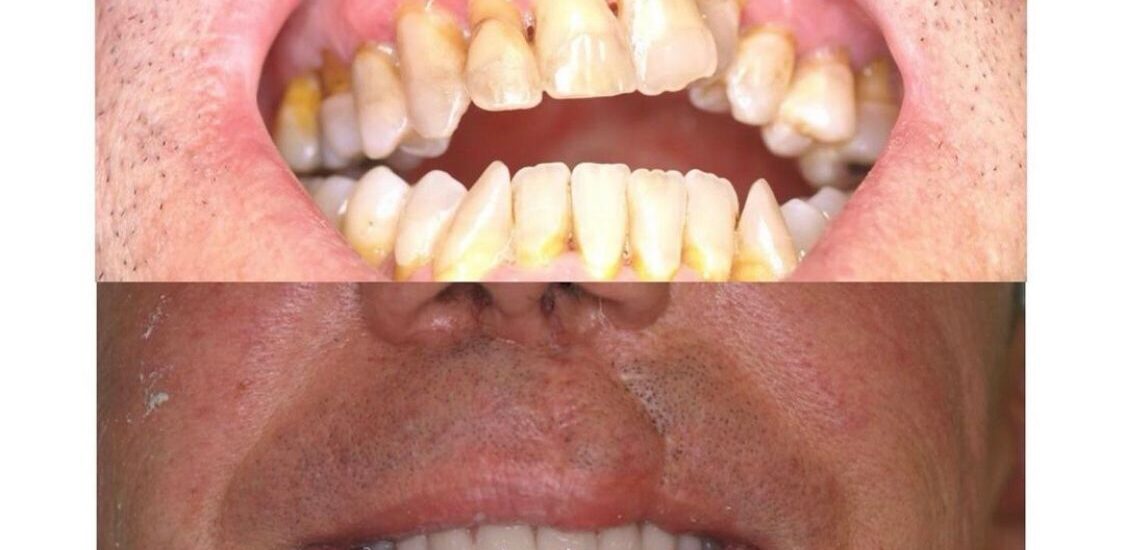 Paciente afecto de labio paladar hendido Dr. Antonio Vázquez, cirujano maxilofacial en Barcelona