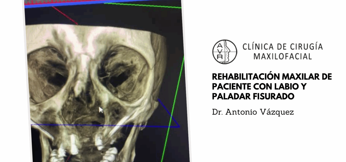 Rehabilitación maxilar de paciente con labio y paladar fisurado Dr. Antonio Vázquez, cirujano maxilofacial en Barcelona