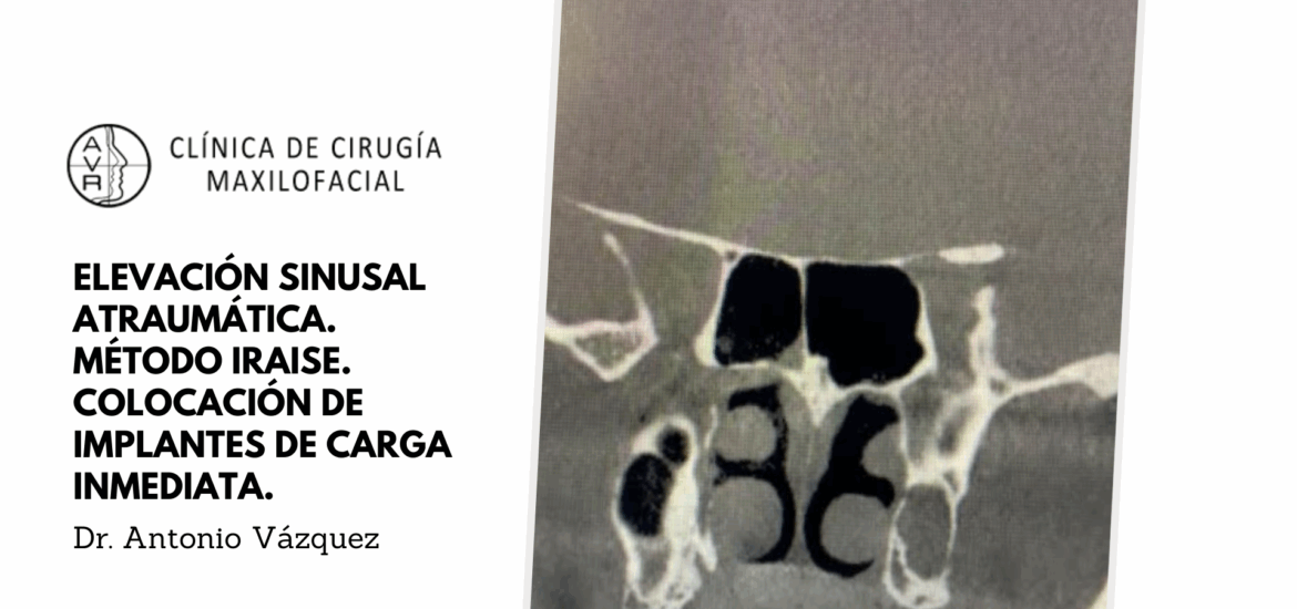 Elevación sinusal atraumática Dr Antonio Vázquez, cirujano maxilofacial en Barcelona