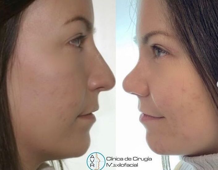 Rinoplastia cerrada de reducción con septoplastia funcional Dr Antonio Vázquez, cirujano maxilofacial en Barcelona