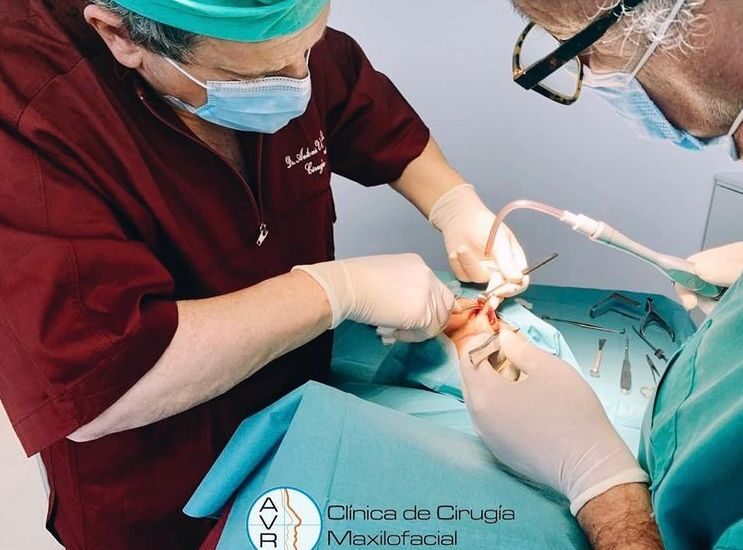 Retoque de la punta y del dorso nasal en nuestra clínica Dr Antonio Vázquez, cirujano maxilofacial en Barcelona