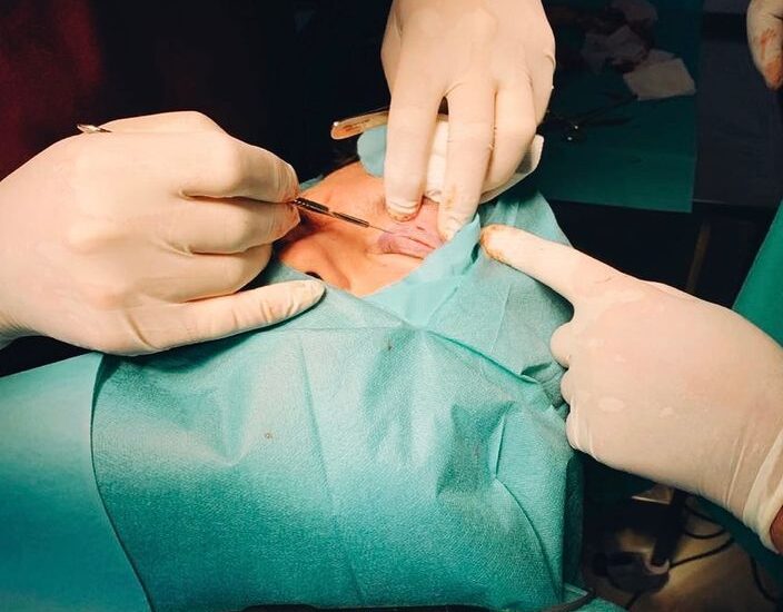 Blefaroplastia superior en hombre Dr Antonio Vázquez, cirujano maxilofacial en Barcelona