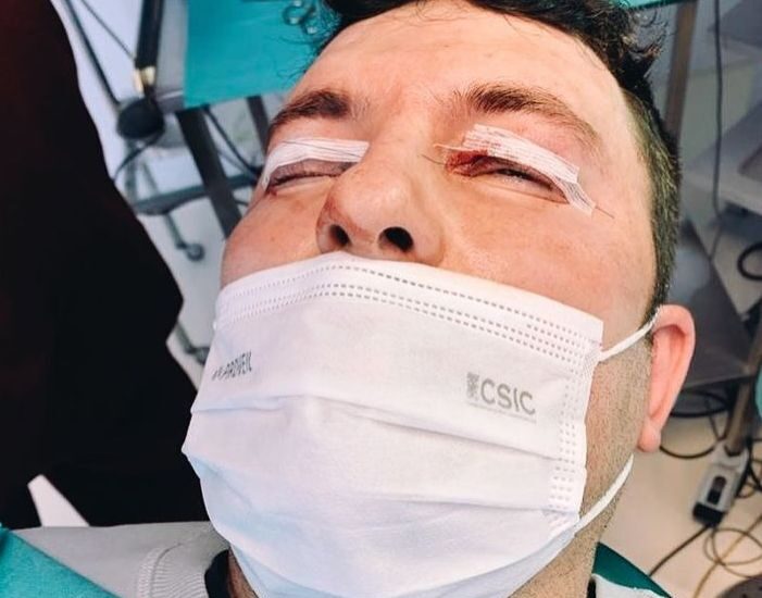 Blefaroplastia superior en hombre Dr Antonio Vázquez, cirujano maxilofacial en Barcelona