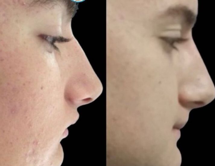 Distracción mandibular Dr Antonio Vázquez, cirujano maxilofacial en Barcelona
