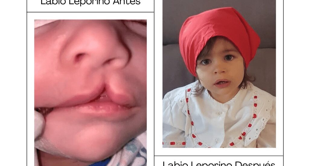 Cirugía del labio leporino en Barcelona Dr. Antonio Vázquez, cirujano maxilofacial en Barcelona