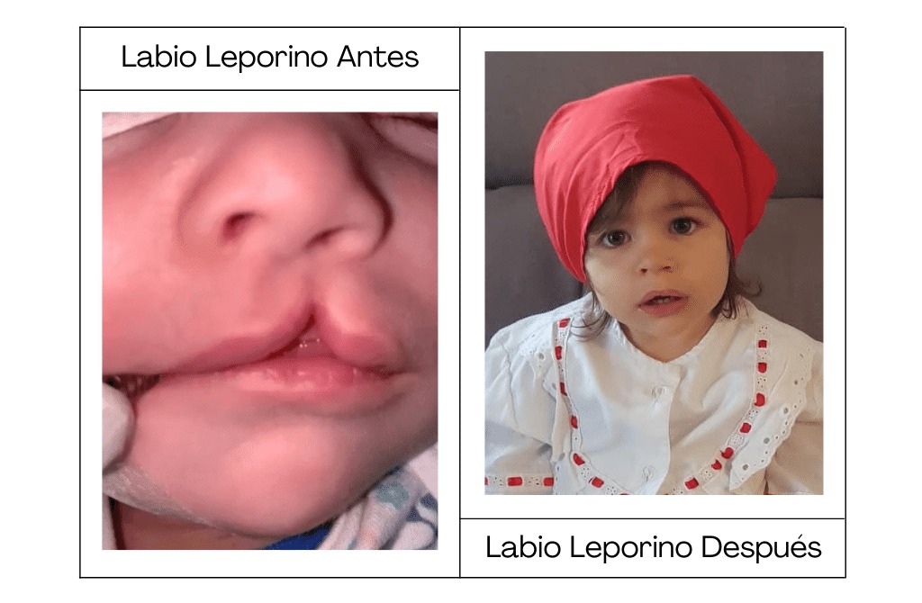 Cirugía del labio leporino en Barcelona Dr. Antonio Vázquez, cirujano maxilofacial en Barcelona
