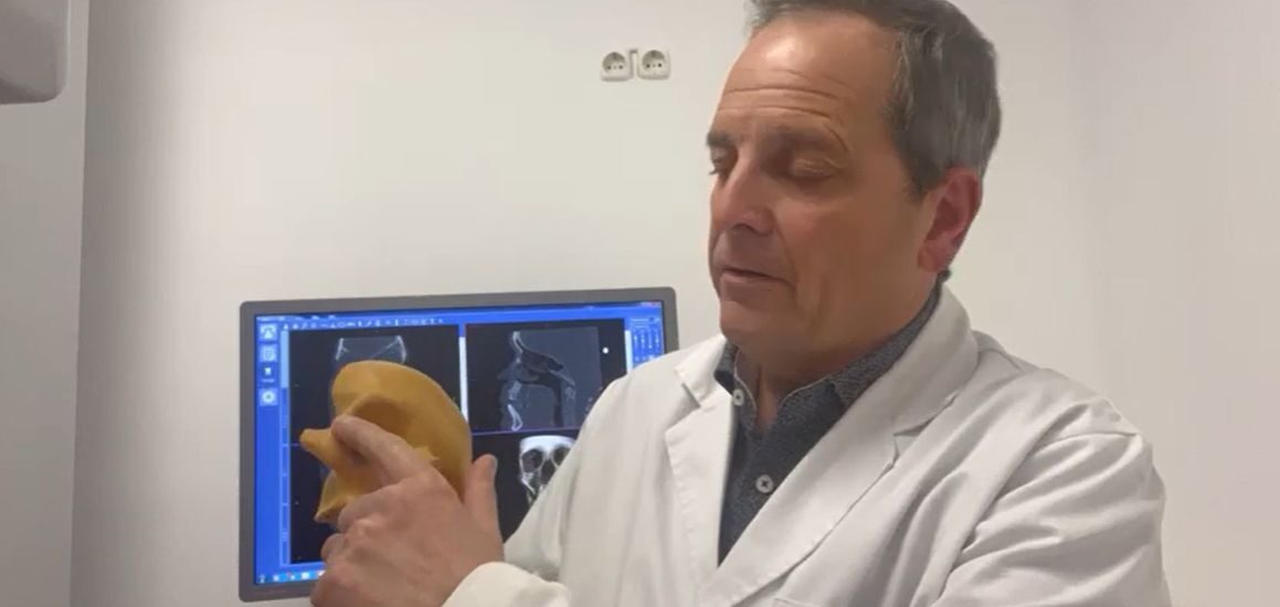 Los implantes cigomáticos son la solución más rápida para pacientes con pérdida de hueso maxilar.