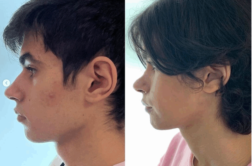 Un nuevo caso de feminización facial exitoso