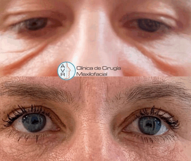 Blefaroplastia superior e inferior Dr Antonio Vázquez, cirujano especialista en Blefaroplastia en Barcelona