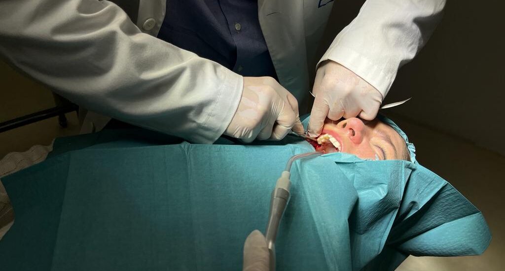 Intervención de cordal incluido con anestesia local en consulta