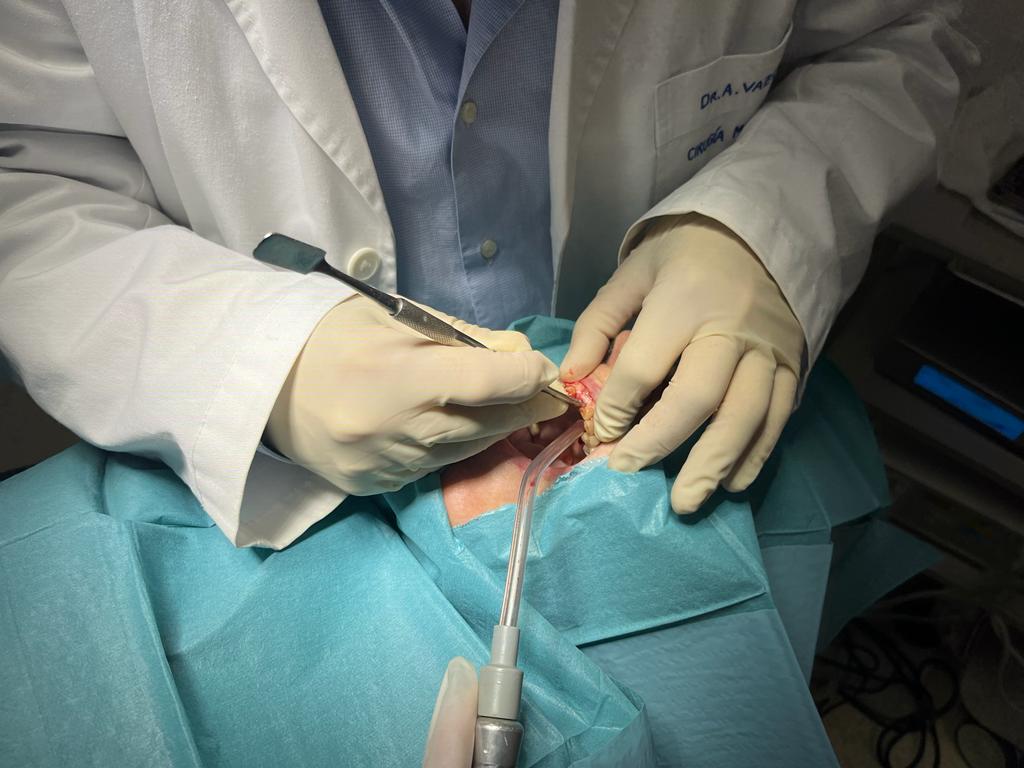 El Dr. Antonio Vázquez y su equipo realizan con éxito una compleja cirugía de implantes osteointegrados en una paciente octogenaria