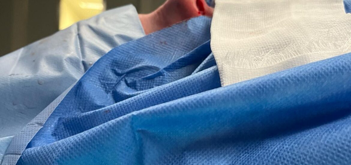 Rinoplastia a los 20 para generar confianza