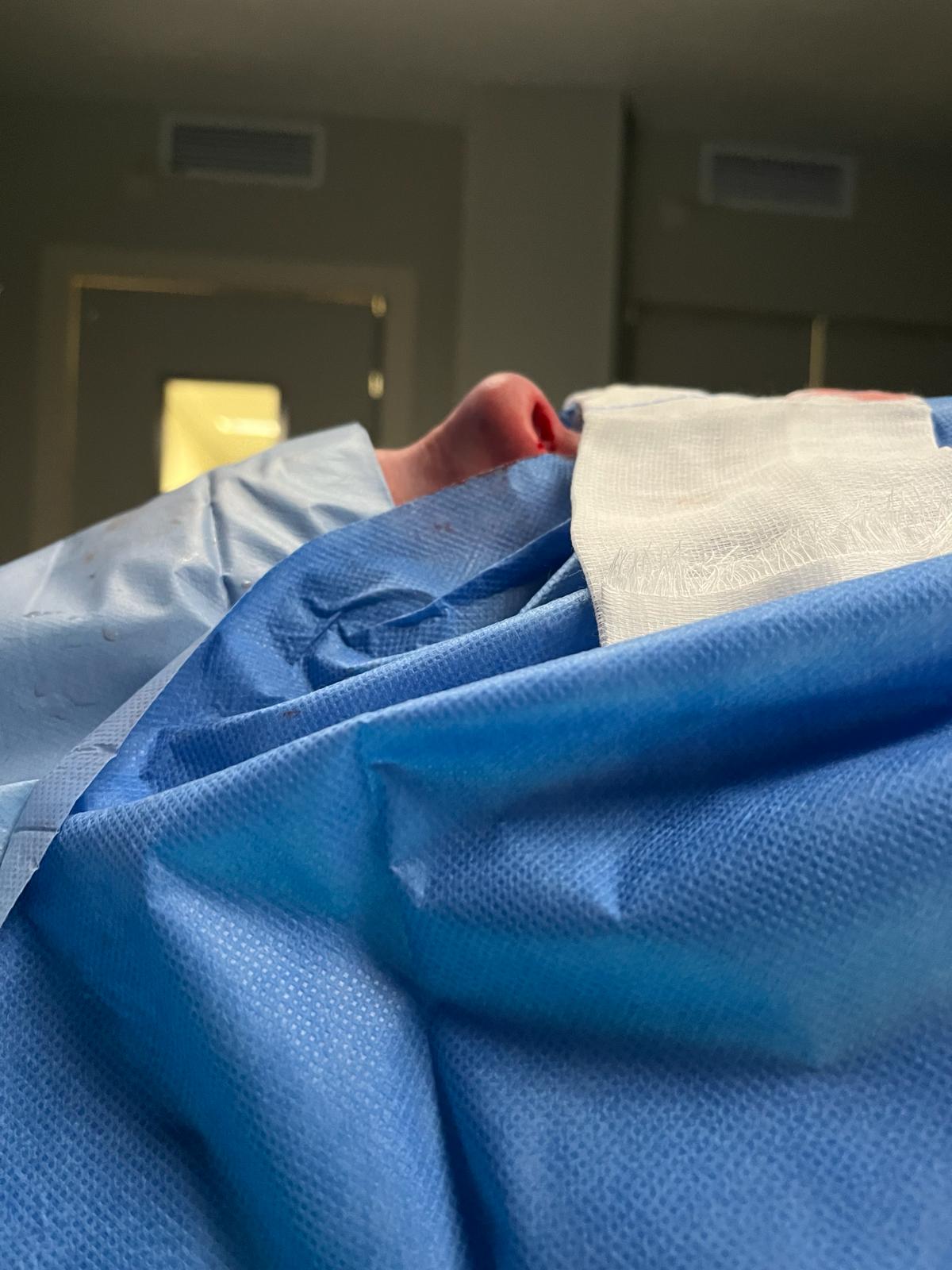 Rinoplastia a los 20 para generar confianza El Dr Vázquez realiza una rinoplastia a una paciente de 20 años en la Clínica del Remei