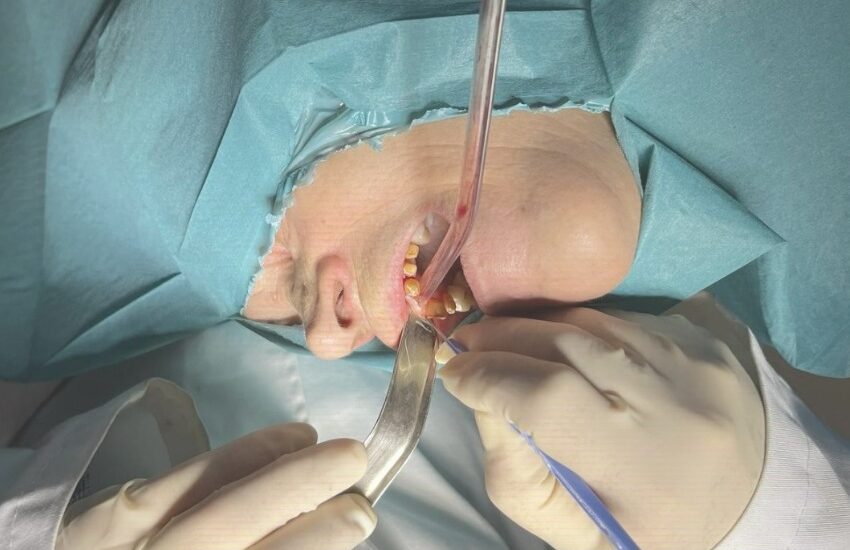 Superando desafíos con una reconstrucción alveolar