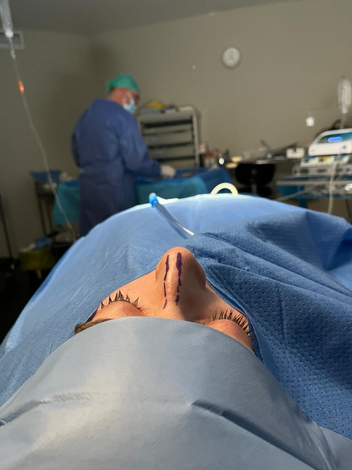 Rinoplastia a los 20 para generar confianza El Dr Vázquez realiza una rinoplastia a una paciente de 20 años en la Clínica del Remei