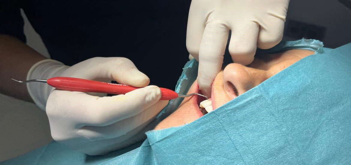 Curetaje más colocación de implantes Un paso más hacia la sonrisa perfecta