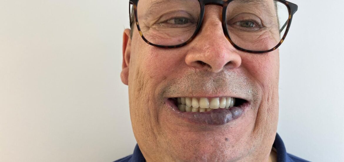 Superando desafíos en cirugía de implantes Un caso de éxito en AVR Maxilofacial