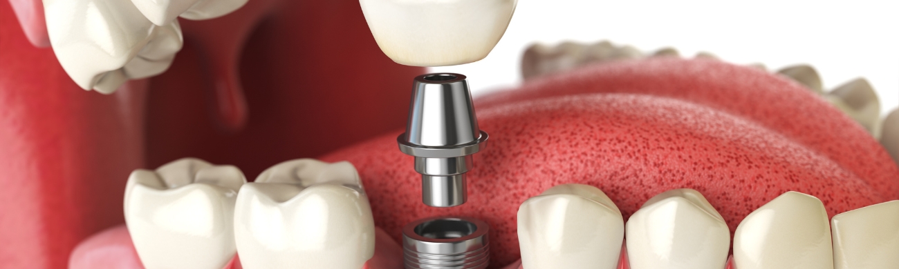Implantes dentales sin cirugía Tratamiento de implantes dentales en AVR Clínica de Cirugía Maxilofacial