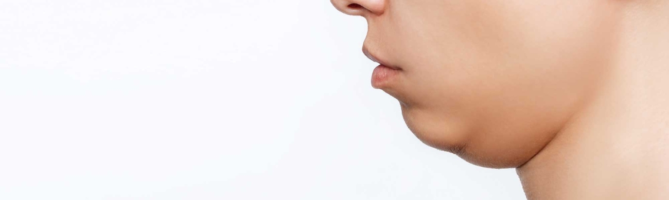 Retrognatia Tratamiento de retrognatia mandibular en AVR Clínica de Cirugía Maxilofacial