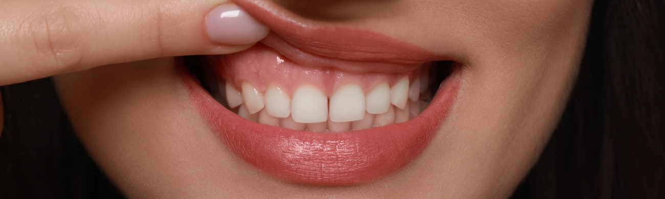 Sonrisa gingival Tratamiento de sonrisa gingival en AVR Clínica de Cirugía Maxilofacial