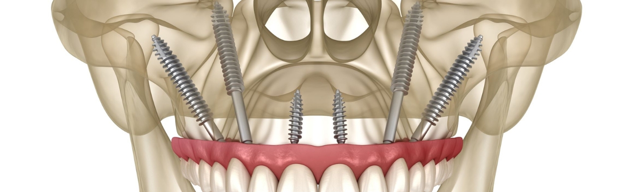 Implantes cigomáticos Tratamiento de implantes cigomáticos en AVR Clínica de Cirugía Maxilofacial