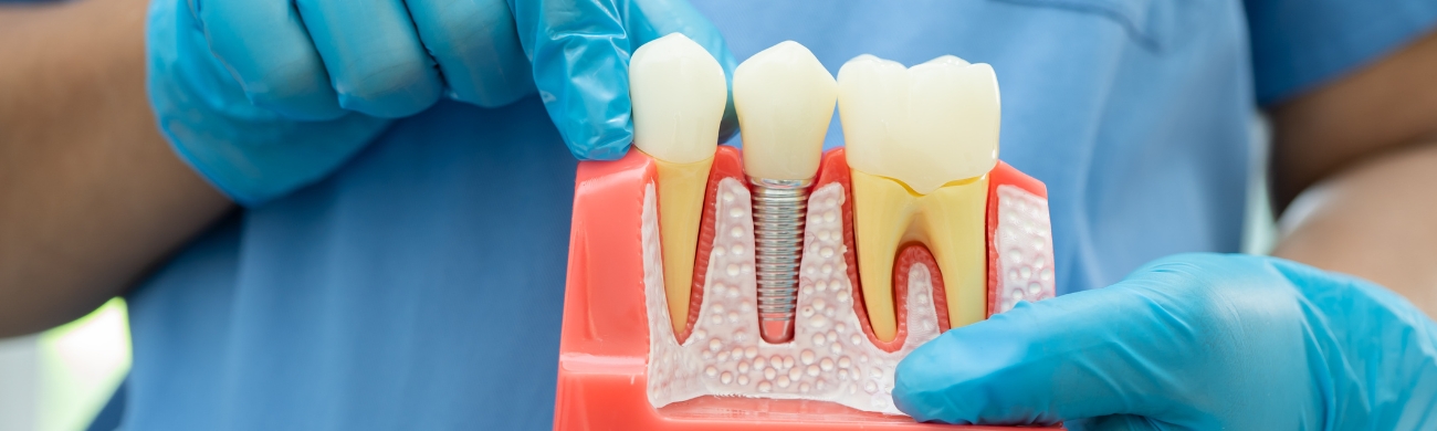 Implantes de carga inmediata Tratamiento de implantes dentales de carga inmediata en AVR Clínica de Cirugía Maxilofacial