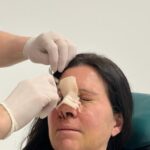 Rinoplastia Tratamiento de Rinoplastia “Rinofast” en AVR Clínica de Cirugía Maxilofacial
