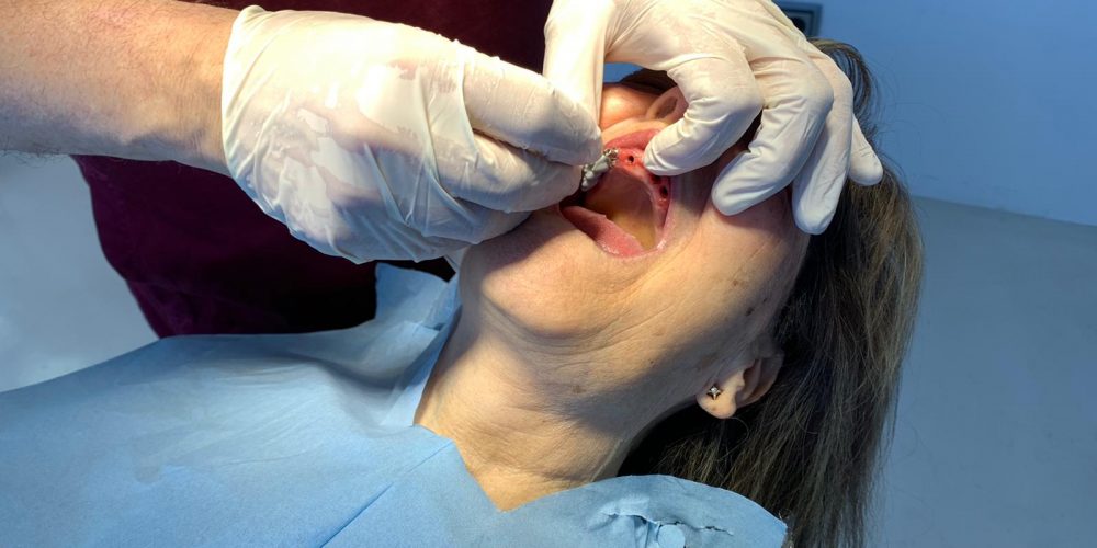 Implantes dentales de circonio en la mandíbula superior
