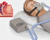 Respiracion con presión positiva (CPAP)