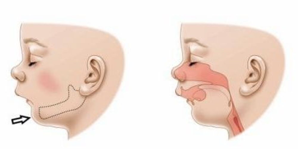 ¿Qué es la distracción mandibular y en qué consiste?