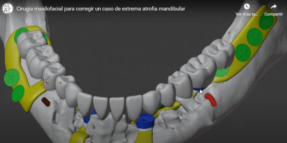 Vídeo de una cirugía maxilofacial para corregir un caso de extrema atrofia mandibular